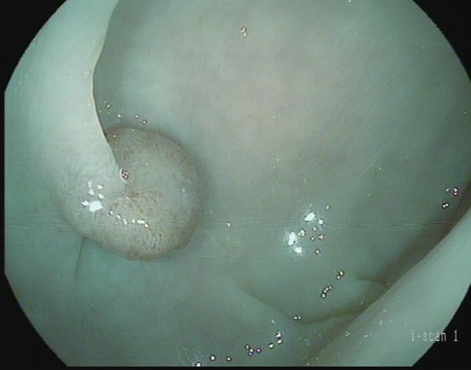 肠镜一照，息肉现形！形态各异的大肠息肉，离癌有多远？(图3)