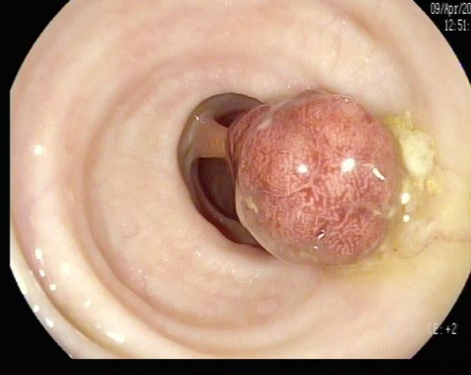 肠镜一照，息肉现形！形态各异的大肠息肉，离癌有多远？(图5)